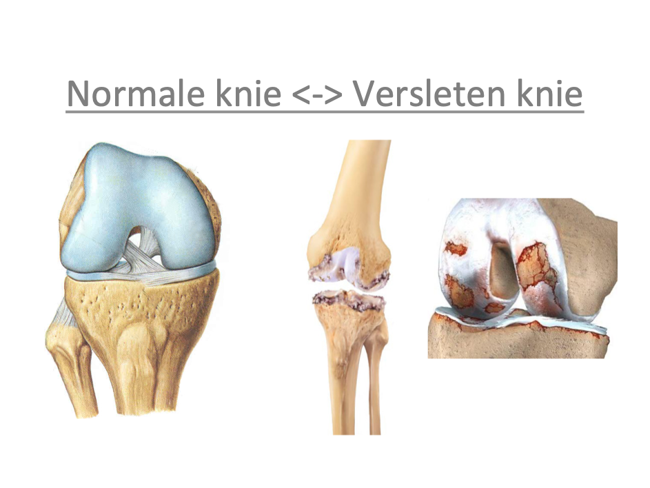 Totale Knie Prothese Orthopedisch Centrum Limburg